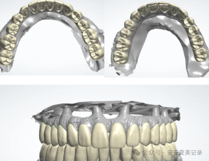 A Comprehensive Analysis of the Advantages and Disadvantages of 3D Printed Dentures: Is the Cost Three Times Higher than Traditional Dentures Justified?