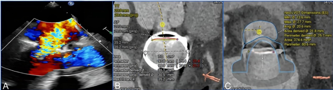 Discussion on the Structure Literature of Xijing｜3D Printing-Assisted Innovative System for Transcatheter Mitral Valve "Valve-in-Ring" Replacement Surgery
