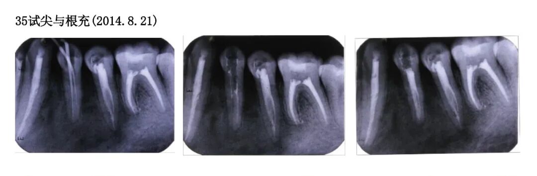 Case Study of C-shaped Root Canal Treatment for the First and Second Premolars in the Left Mandible