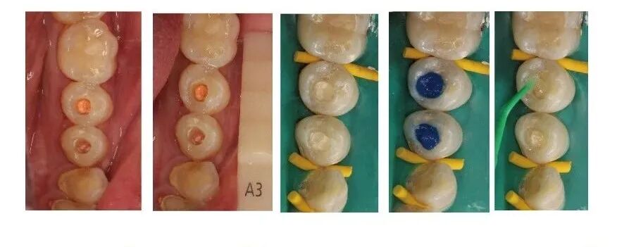 Case Study of C-shaped Root Canal Treatment for the First and Second Premolars in the Left Mandible