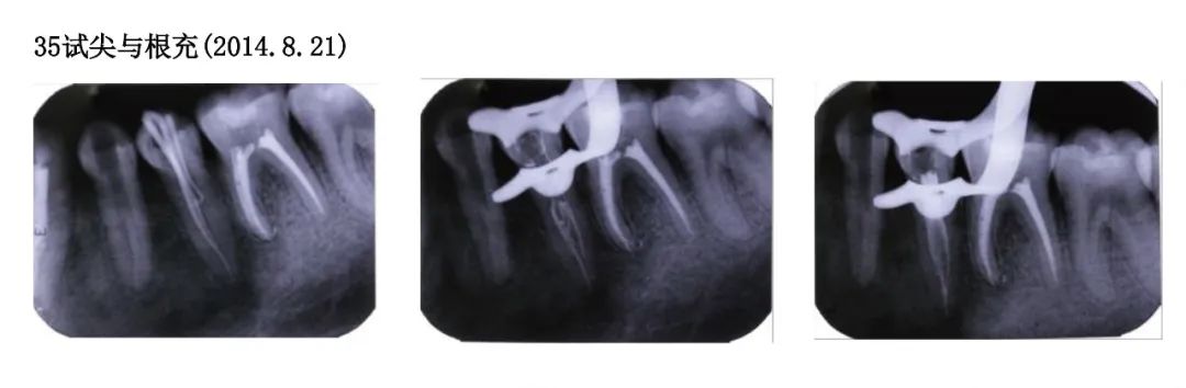 Case Study of C-shaped Root Canal Treatment for the First and Second Premolars in the Left Mandible