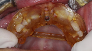 Application of 3D Printing in Digital Implant Surgical Guides