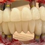 A Comprehensive Analysis of the Advantages and Disadvantages of 3D Printed Dentures: Is the Cost Three Times Higher than Traditional Dentures Justified?
