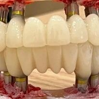 A Comprehensive Analysis of the Advantages and Disadvantages of 3D Printed Dentures: Is the Cost Three Times Higher than Traditional Dentures Justified?