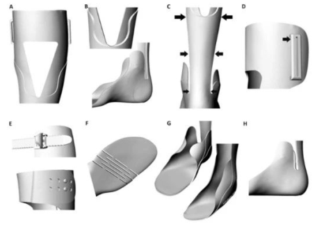 Application of 3D Printing in the Treatment of Talus Bridge