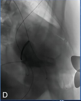 Discussion on the Structure Literature of Xijing｜3D Printing-Assisted Innovative System for Transcatheter Mitral Valve "Valve-in-Ring" Replacement Surgery