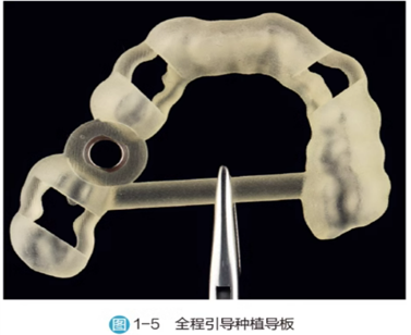 Application of 3D Printing in Digital Implant Surgical Guides