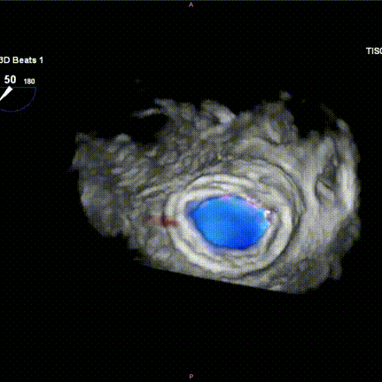 Discussion on the Structure Literature of Xijing｜3D Printing-Assisted Innovative System for Transcatheter Mitral Valve "Valve-in-Ring" Replacement Surgery