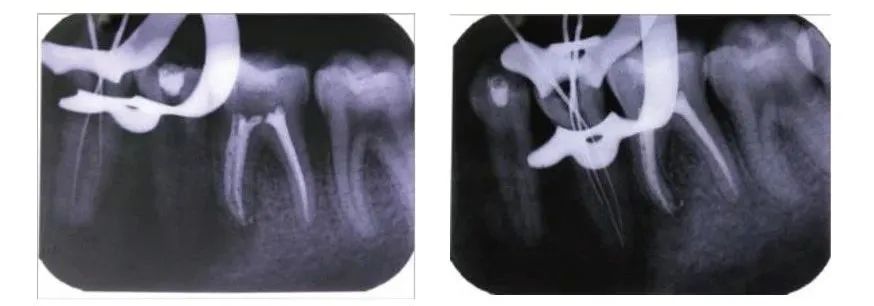 Case Study of C-shaped Root Canal Treatment for the First and Second Premolars in the Left Mandible