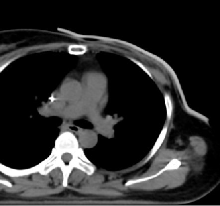 3D Printing! Customized Shields for Breast Cancer Patients Undergoing Radiotherapy