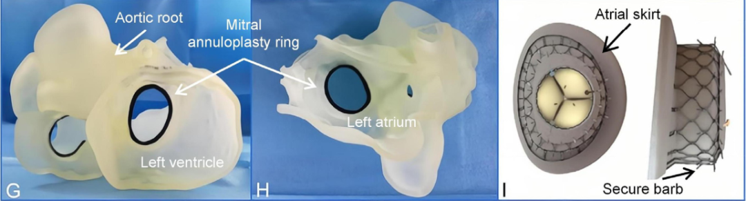 Discussion on the Structure Literature of Xijing｜3D Printing-Assisted Innovative System for Transcatheter Mitral Valve "Valve-in-Ring" Replacement Surgery
