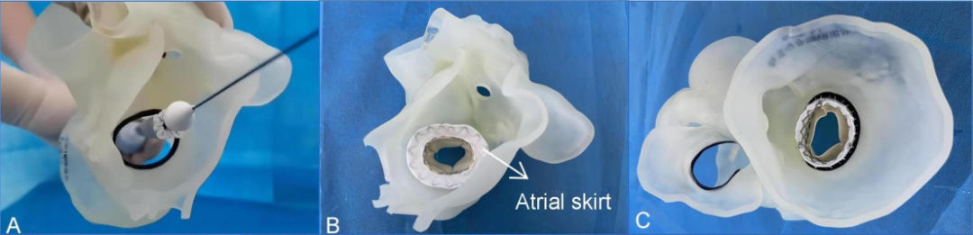 Discussion on the Structure Literature of Xijing｜3D Printing-Assisted Innovative System for Transcatheter Mitral Valve "Valve-in-Ring" Replacement Surgery