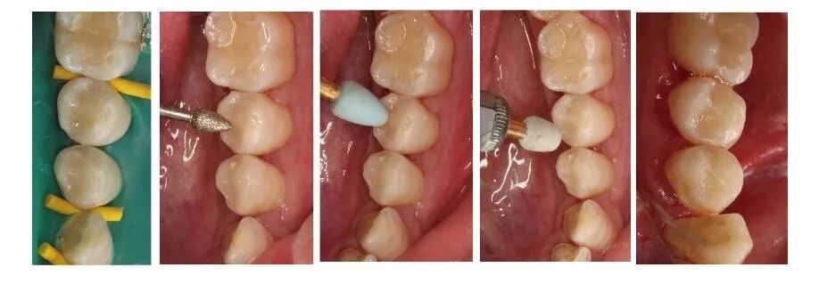 Case Study of C-shaped Root Canal Treatment for the First and Second Premolars in the Left Mandible