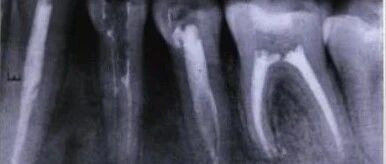 Case Study of C-shaped Root Canal Treatment for the First and Second Premolars in the Left Mandible