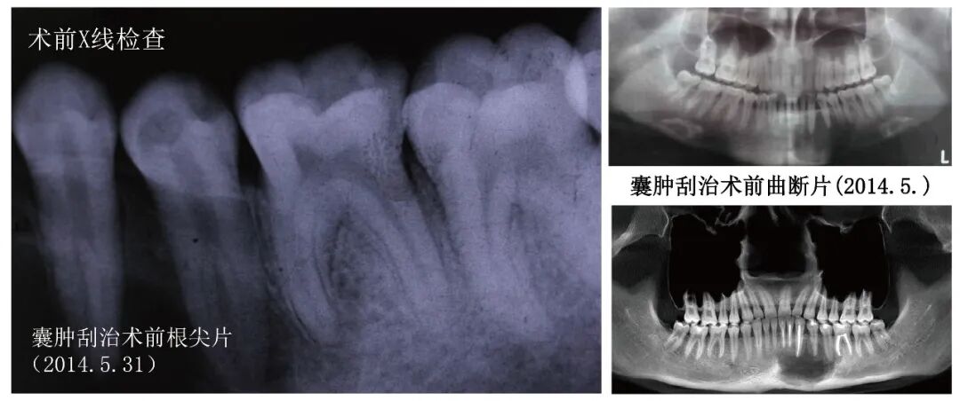 Case Study of C-shaped Root Canal Treatment for the First and Second Premolars in the Left Mandible