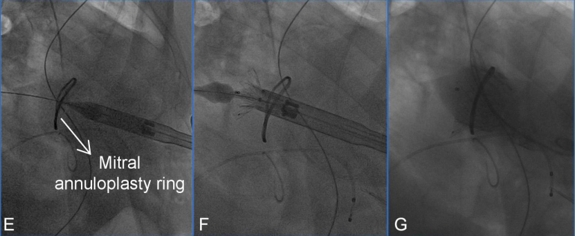 Discussion on the Structure Literature of Xijing｜3D Printing-Assisted Innovative System for Transcatheter Mitral Valve "Valve-in-Ring" Replacement Surgery