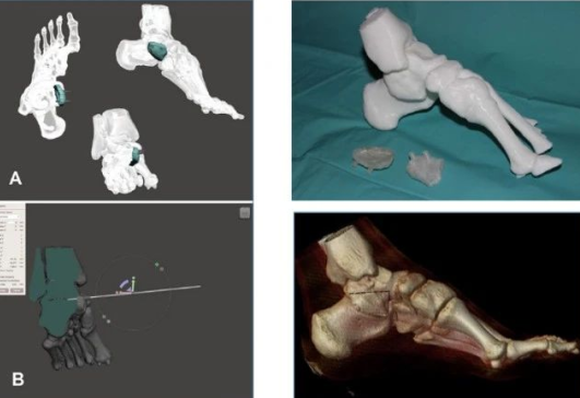 Application of 3D Printing in the Treatment of Talus Bridge
