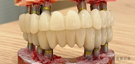 A Comprehensive Analysis of the Advantages and Disadvantages of 3D Printed Dentures: Is the Cost Three Times Higher than Traditional Dentures Justified?