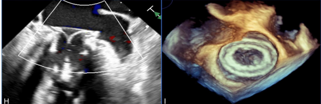 Discussion on the Structure Literature of Xijing｜3D Printing-Assisted Innovative System for Transcatheter Mitral Valve "Valve-in-Ring" Replacement Surgery