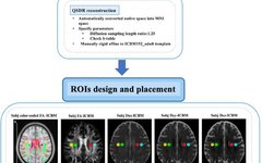 Evaluation of the Lymphatic System Function Using Diffusion Tensor Imaging Analysis Along the Perivascular Space (DTI-ALPS): A Cross-Vendor Test-Retest Validation