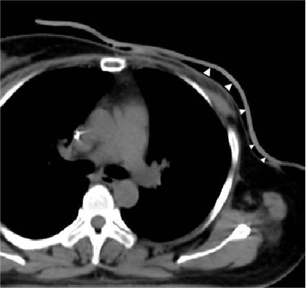 3D Printing! Customized Shields for Breast Cancer Patients Undergoing Radiotherapy