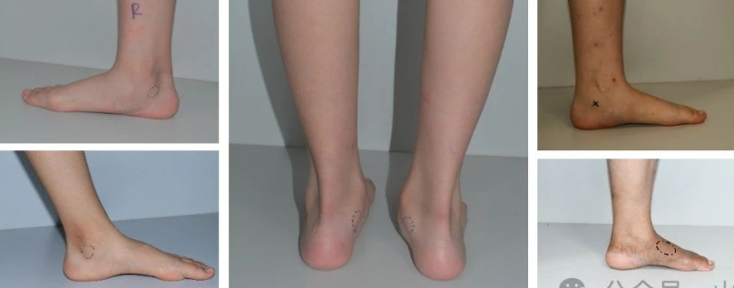 Application of 3D Printing in the Treatment of Talus Bridge