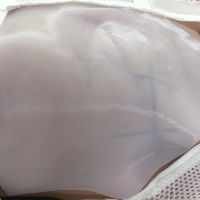 3D Printing! Customized Shields for Breast Cancer Patients Undergoing Radiotherapy