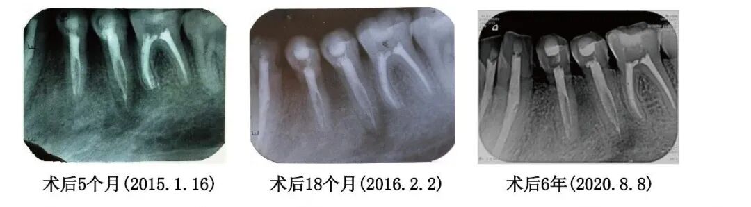 Case Study of C-shaped Root Canal Treatment for the First and Second Premolars in the Left Mandible