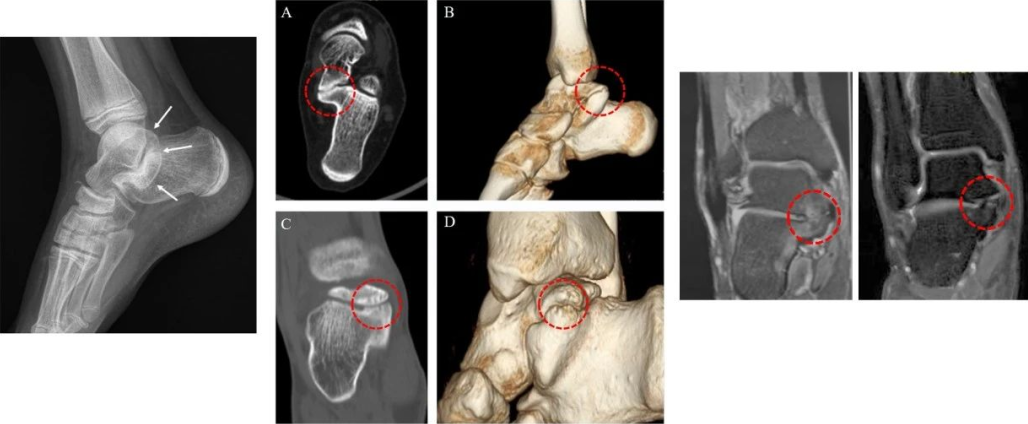 Application of 3D Printing in the Treatment of Talus Bridge