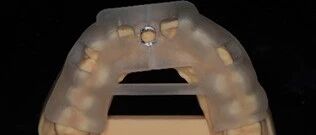 Application of 3D Printing in Digital Implant Surgical Guides