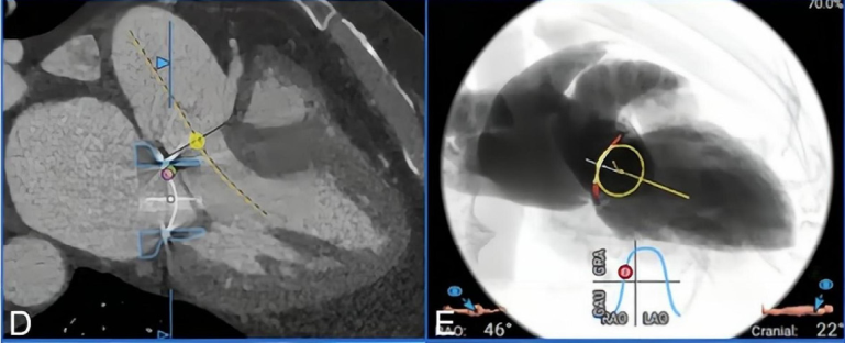 Discussion on the Structure Literature of Xijing｜3D Printing-Assisted Innovative System for Transcatheter Mitral Valve "Valve-in-Ring" Replacement Surgery
