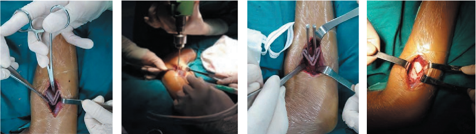 Application of 3D Printing Technology in Orthopedics