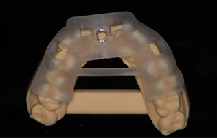 Application of 3D Printing in Digital Implant Surgical Guides