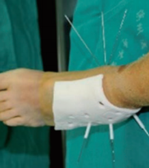 Application of 3D Printing Technology in Orthopedics