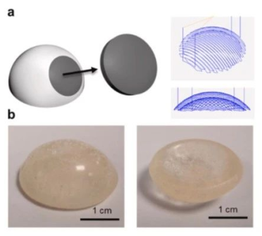 Application of 3D Printing in the Treatment of Talus Bridge