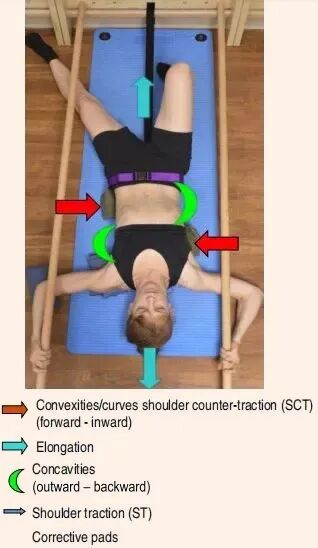 Introduction of Barcelona BSPTS: A New International Solution for Scoliosis Correction