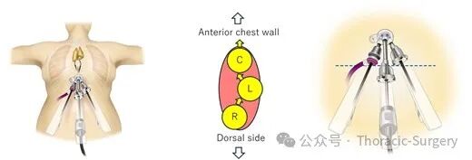 Sternum-Based Single-Port Robotic Thymectomy Using the Da Vinci Xi System