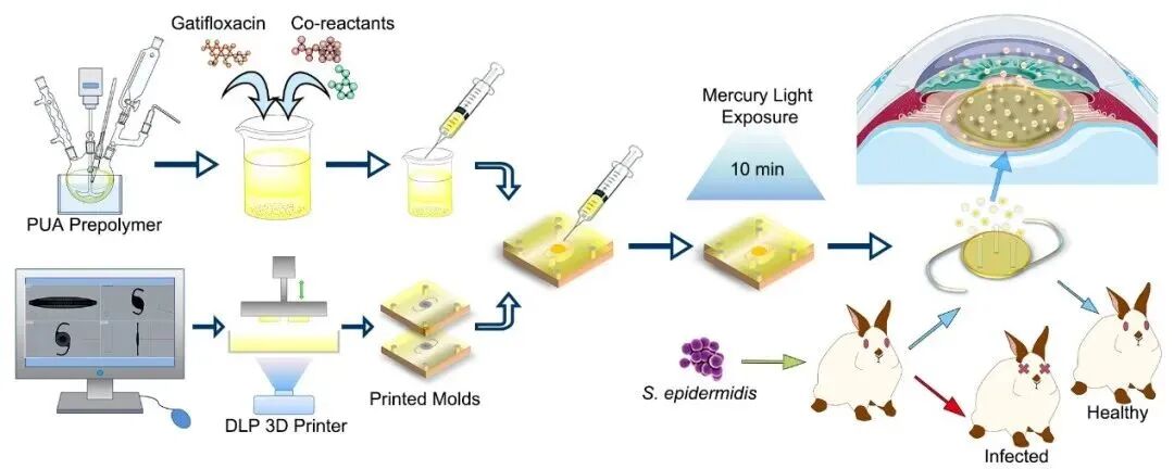 A Novel 3D Printed Antibiotic-Loaded Intraocular Lens: A Breakthrough for Post-Cataract Endophthalmitis Patients!