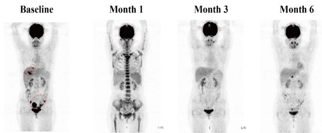 Objective Response Rate Reaches 80%! GCC19CAR-T Brings New Hope to Patients with Advanced Colorectal Cancer