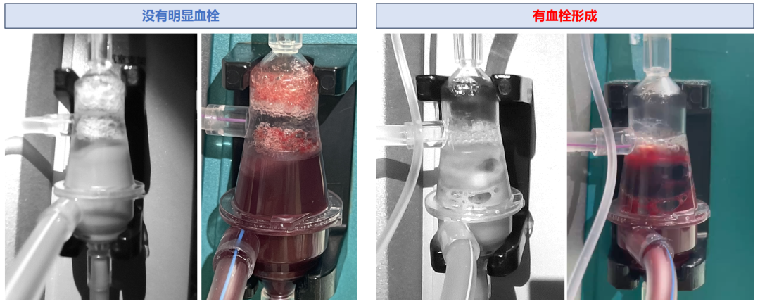 Professor Zhang Ling: Advances and Breakthroughs in Severe Blood Purification Technology