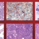 Evaluation of Morphology in Myeloid Neoplasms: ICC Series Part Three