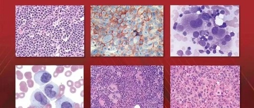 Evaluation of Morphology in Myeloid Neoplasms: ICC Series Part Three