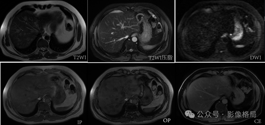 Multifocal Hepatic Steatosis