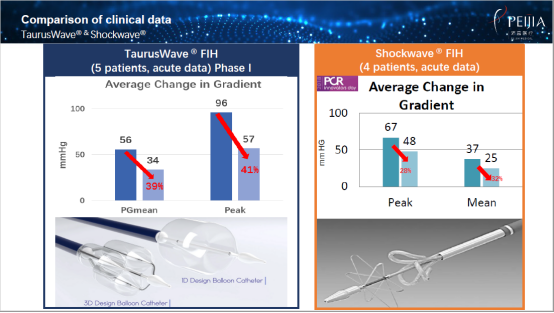 Intravascular Shockwave Balloon Catheter: Key Shockwave Patent Invalidated, Is a Spring for Domestic Devices Approaching?