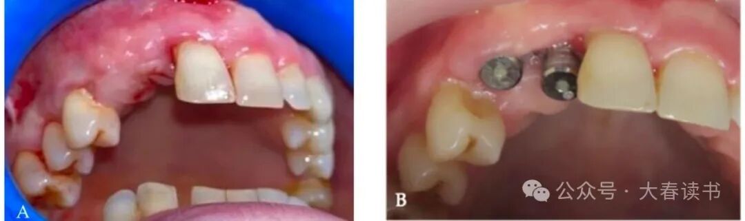 Literature Review: Application of Customized 3D-Printed Titanium Mesh in Complex Bone Defects after Odontectomy in the Aesthetic Zone: A Case Report