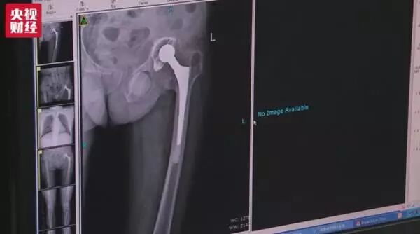 Amazing High-Tech! 3D Printed Human Bones Are Actually Used in Surgery...