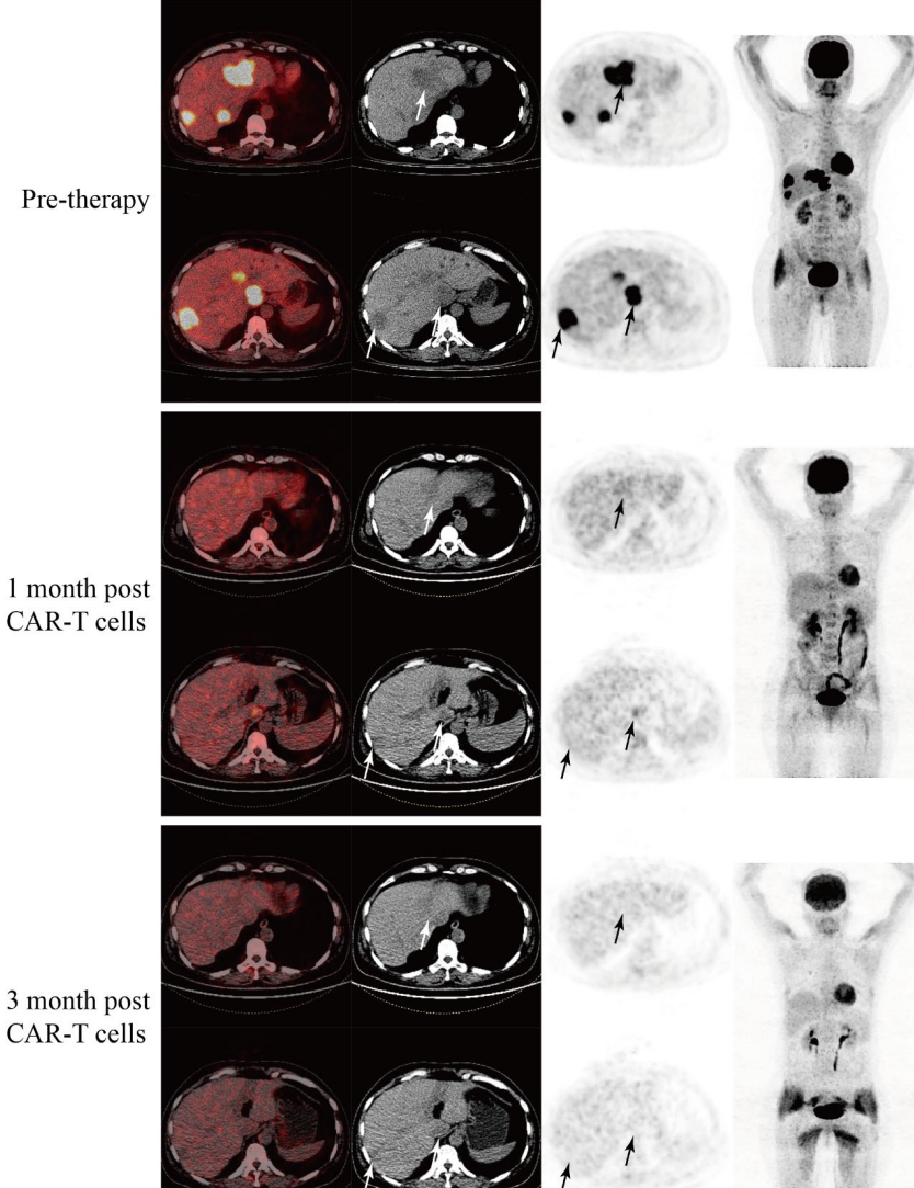 Objective Response Rate Reaches 80%! GCC19CAR-T Brings New Hope to Patients with Advanced Colorectal Cancer