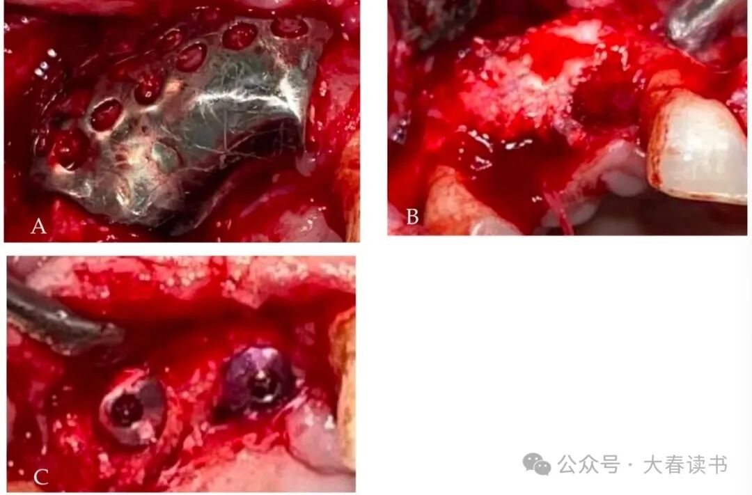 Literature Review: Application of Customized 3D-Printed Titanium Mesh in Complex Bone Defects after Odontectomy in the Aesthetic Zone: A Case Report