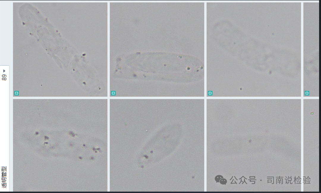 Morphology 121: Urine - Transparent Casts (Instrument-Assisted Diagnosis)
