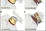 Comprehensive Review: Left Atrial Appendage Occlusion - Progress and Challenges